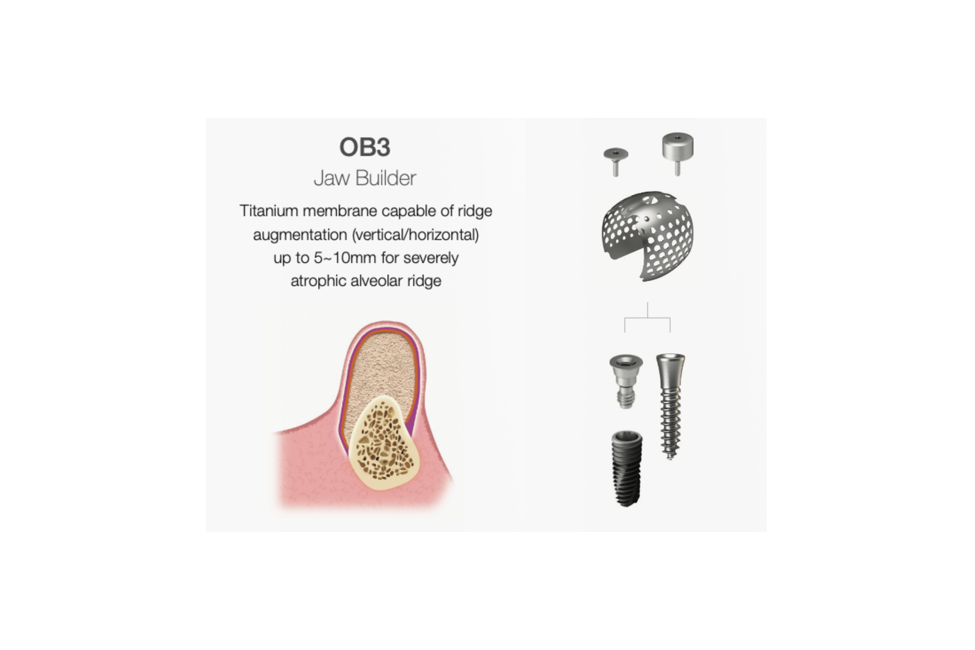 OssBuilder OB3, Jaw Builder horisontal 10 mm – Weesgaard Dental.com
